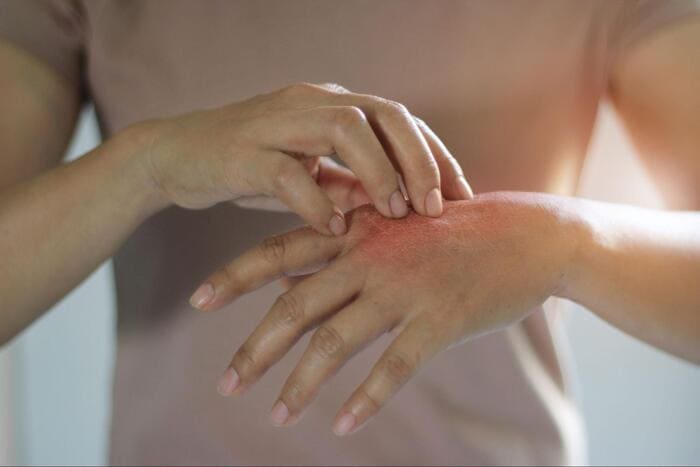 Nên hạn chế sử dụng găng tay Latex với những người có làn da nhạy cảm, dễ bị kích ứng bởi mủ cao su tự nhiên (Nguồn ảnh: Sưu tầm)