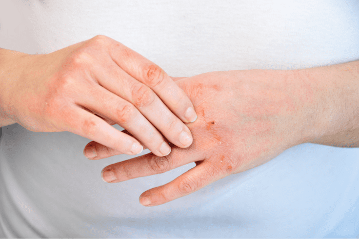 Găng tay y tế có bột có thể gây dị ứng cho những người có cơ địa nhạy cảm