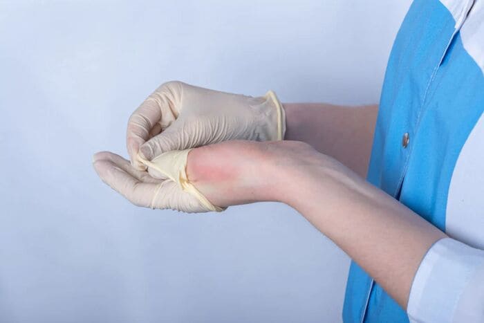 Cần ngưng sử dụng găng tay khi có hiện tượng kích ứng, nổi mẩn đỏ hoặc ngứa ngáy khó chịu (Nguồn ảnh: Sưu tầm)