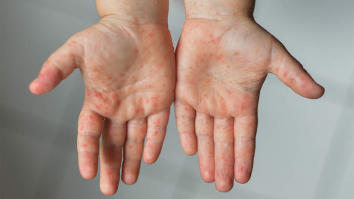 Găng tay cao su công nghiệp không phù hợp cho những người bị dị ứng mủ cao su tự nhiên (Nguồn: Sưu tầm)