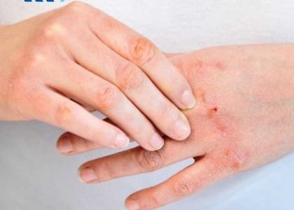 Tác động của hoá chất lên da tay